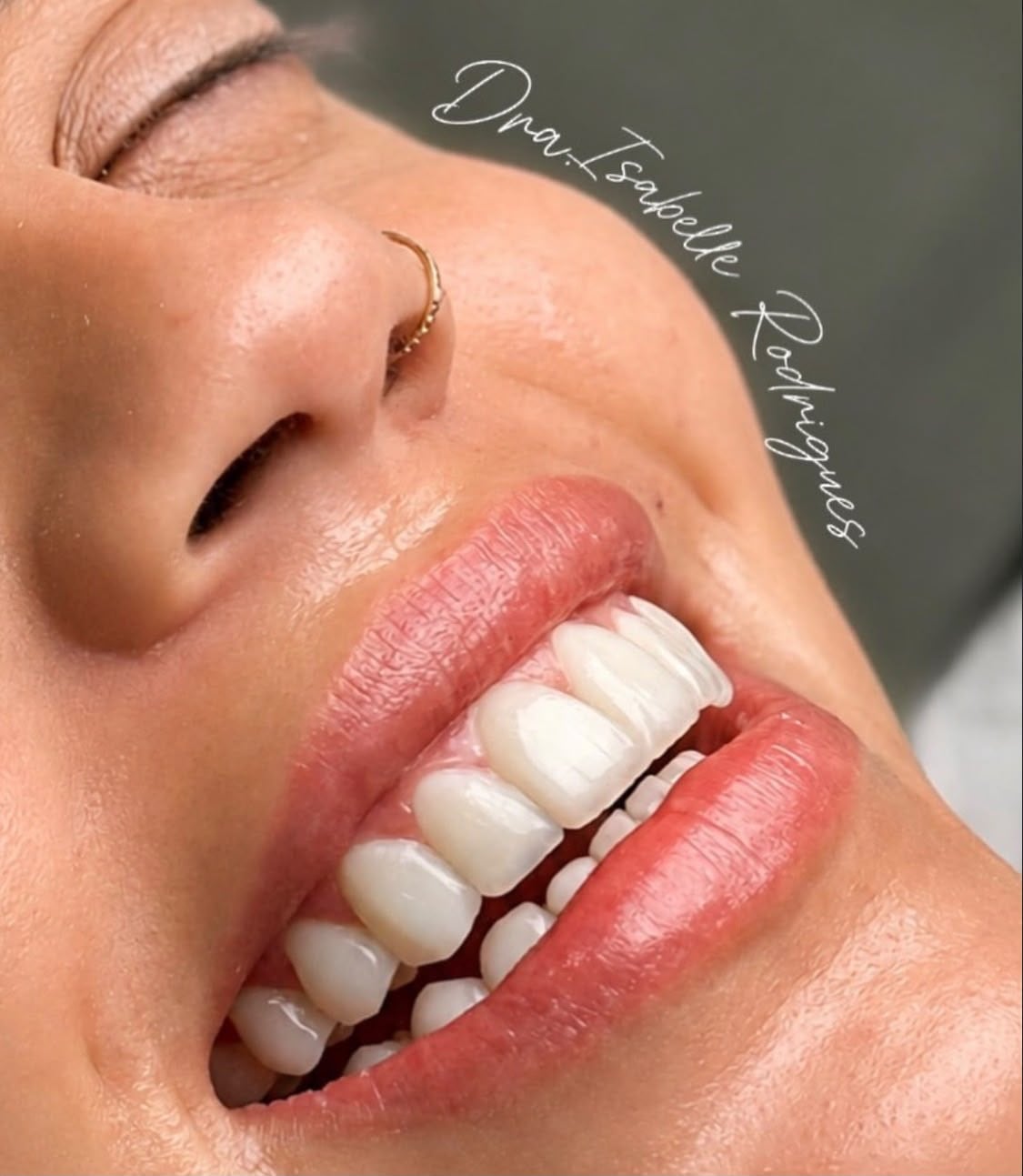 Sorriso de paciente após tratamento estético