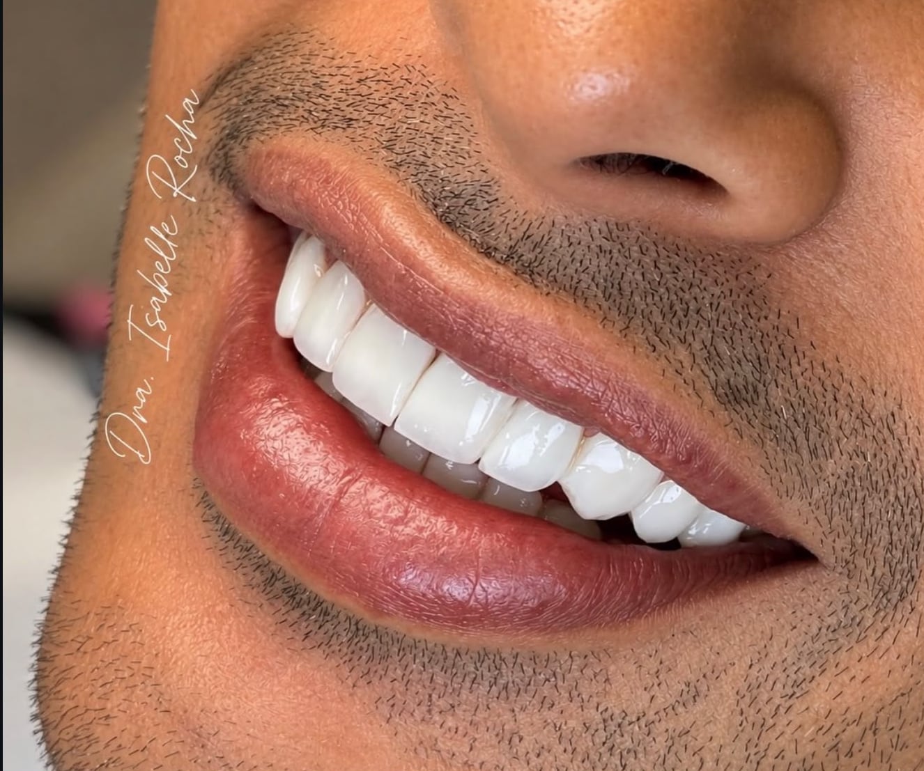 Sorriso de paciente após reabilitação estética